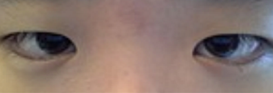 Before: Non incisional double eyelid with ptosis correction, two weeks after surgery