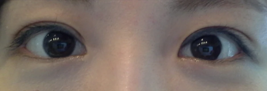 After: Revision surgery for a loosened fold, two months after surgery
