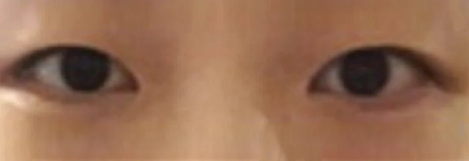 Before: Incisional double eyelid surgery with ptosis correction, one month after surgery