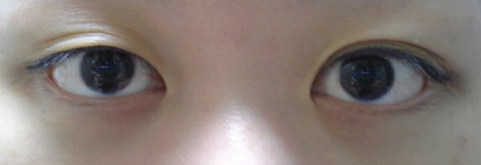 Before: Revision surgery for a loosened fold, one month after surgery