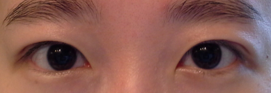 After: Incisional ptosis correction, one month after surgery