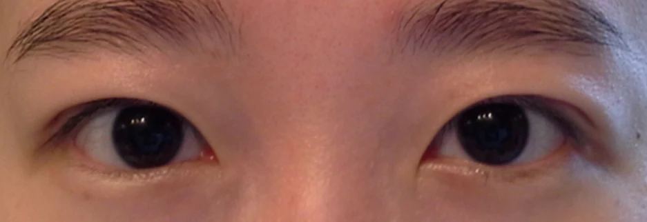 After: Incisional ptosis correction, one month after surgery