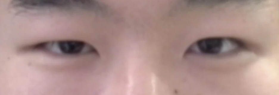 Before: Men's incisional ptosis correction, two months after surgery