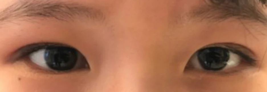 After: Incisional ptosis correction, one month after surgery