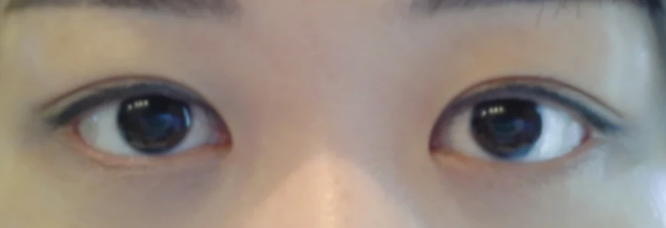 After: Revision surgery for a loosened fold, one month after surgery