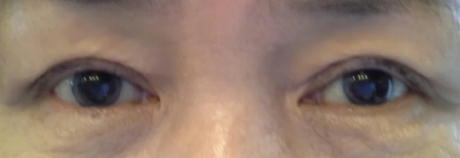 After: Upper blepharoplasty for a woman in her 60s, two months after surgery