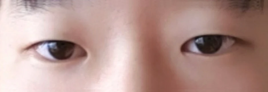 Before: Men's incisional ptosis correction, two months after surgery
