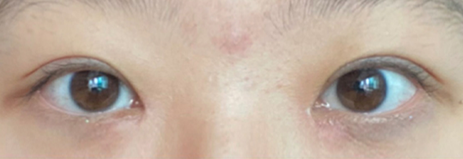 After: Non incisional double eyelid with ptosis correction, one month after surgery