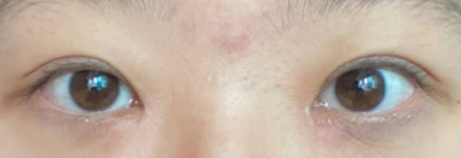 After: Non incisional double eyelid with ptosis correction, one month after surgery