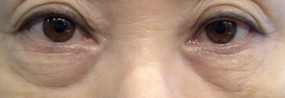 Before: Lower blepharoplasty for a woman in her 60s, four days after surgery