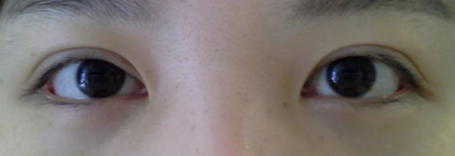 Before: Revision surgery to lower a high fold, three months after surgery