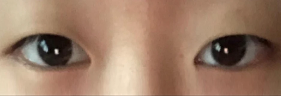 Before: Incisional double eyelid surgery with ptosis correction, one month after surgery