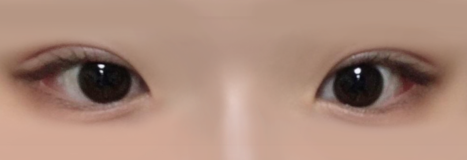 After: Incisional ptosis correction with lateral canthoplasty, one month after surgery