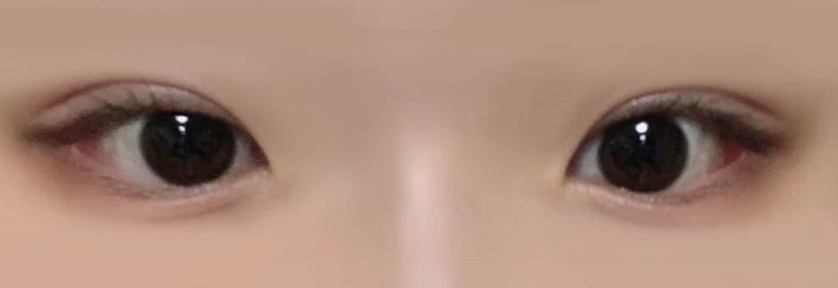 After: Incisional double eyelid surgery with ptosis correction, one month after surgery