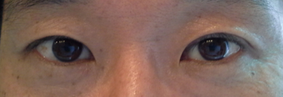 After: Upper blepharoplasty for a man in his 50s, three months after surgery