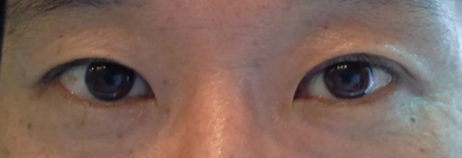After: Upper blepharoplasty for a man in his 50s, three months after surgery