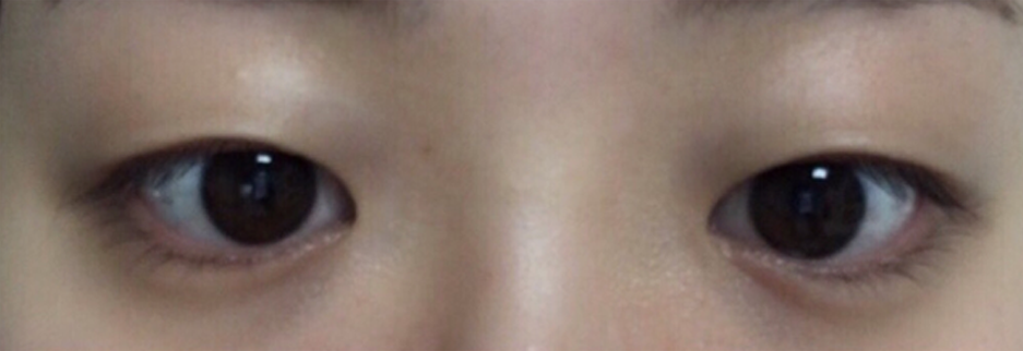 Before: Incisional ptosis correction, one month after surgery