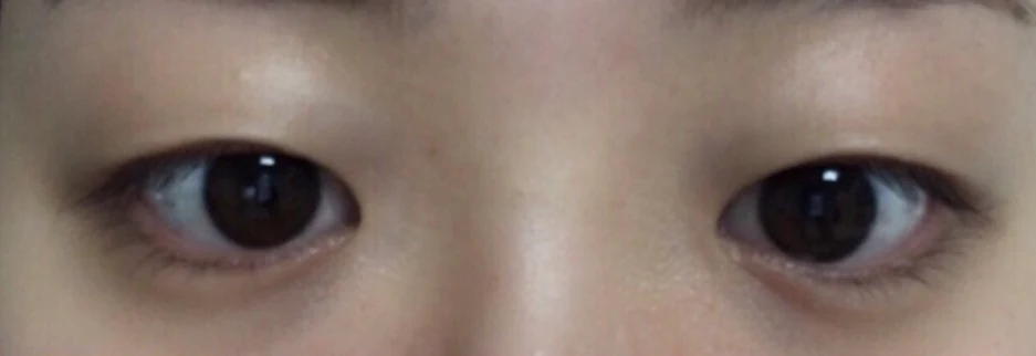 Before: Incisional ptosis correction, one month after surgery