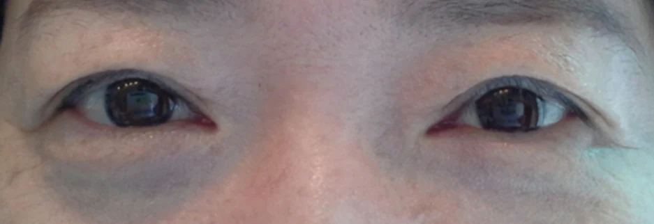 After: Upper blepharoplasty for a woman in her 50s, three months after surgery