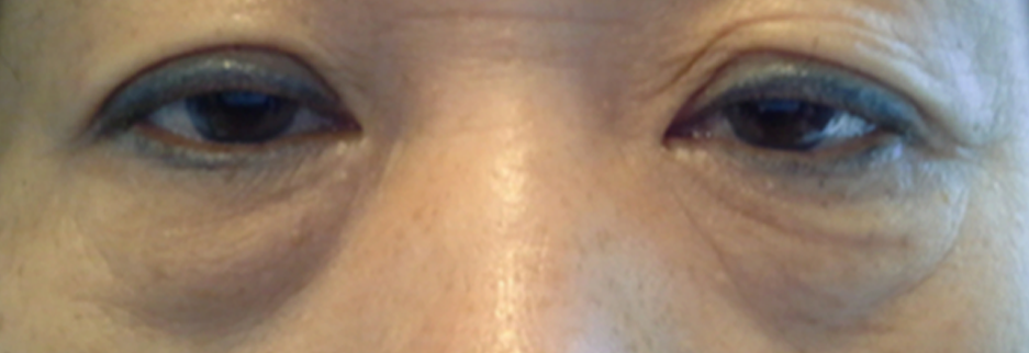 Before: Lower blepharoplasty for a woman in her 50s, four days after surgery