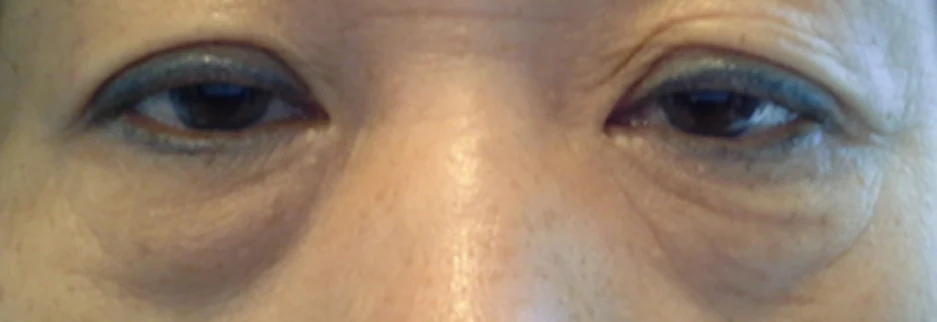 Before: Lower blepharoplasty for a woman in her 50s, four days after surgery