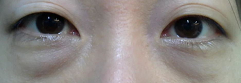 Before: Under eye fat repositioning, one month after surgery