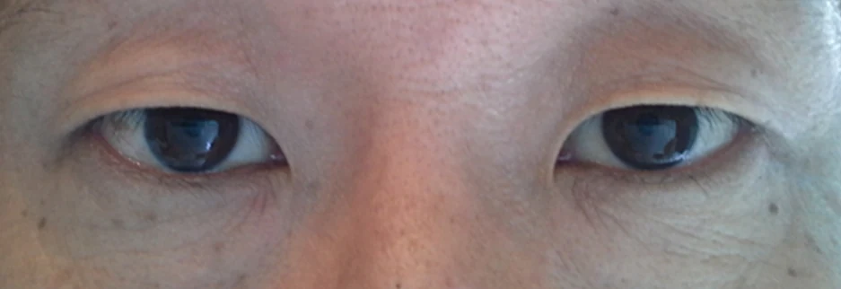 Before: Upper blepharoplasty for a man in his 50s, three months after surgery