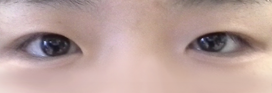 Before: Incisional ptosis correction with lateral canthoplasty, one month after surgery