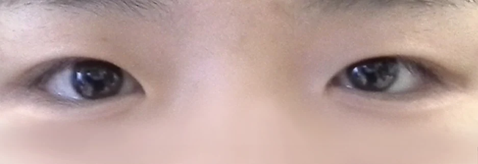 Before: Incisional double eyelid surgery with ptosis correction, one month after surgery