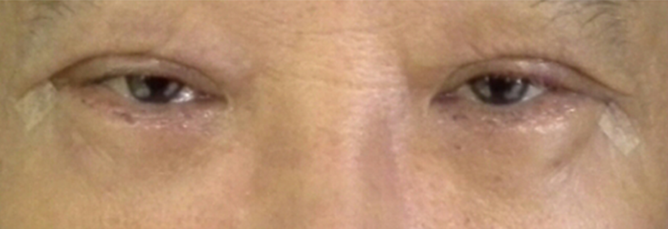 After: Lower blepharoplasty for a man in his 70s, four days after surgery