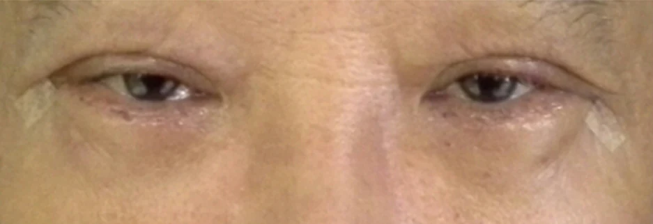 After: Lower blepharoplasty for a man in his 70s, four days after surgery