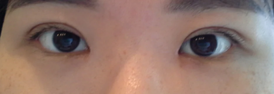 After: Epicanthoplasty, one month after surgery