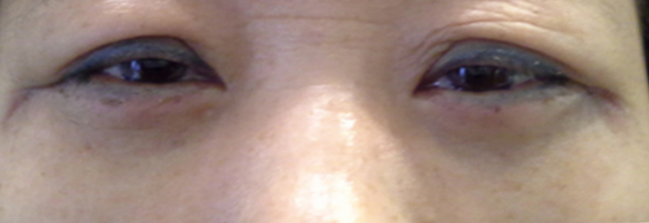 After: Lower blepharoplasty for a woman in her 50s, four days after surgery