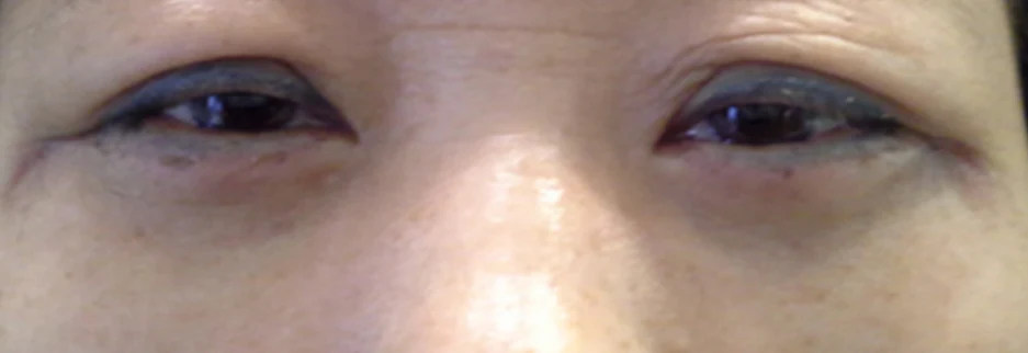 After: Lower blepharoplasty for a woman in her 50s, four days after surgery