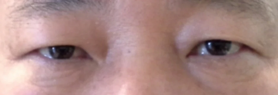 Before: Upper blepharoplasty for a man in his 50s, three months after surgery