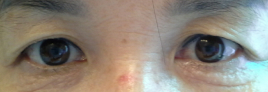 Before: Upper blepharoplasty for a woman in her 60s, two months after surgery