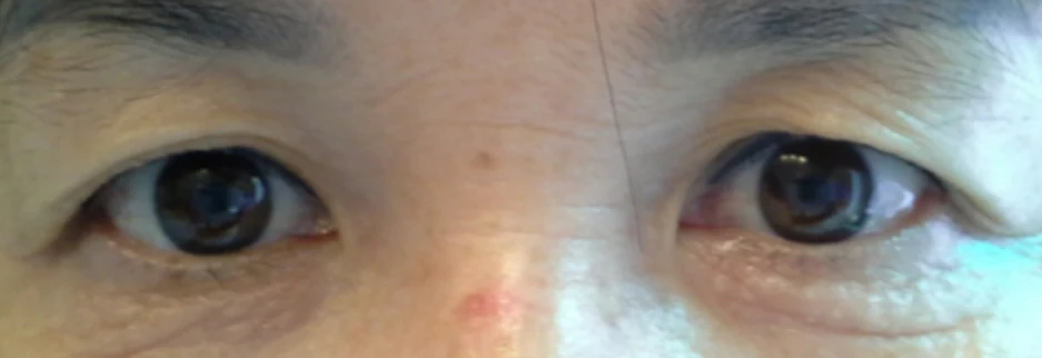 Before: Upper blepharoplasty for a woman in her 60s, two months after surgery