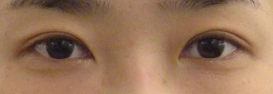 After: Incisional double eyelid surgery with ptosis correction, one month after surgery