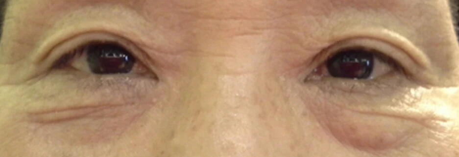 Before: Lower blepharoplasty for a woman in her 60s, four days after surgery