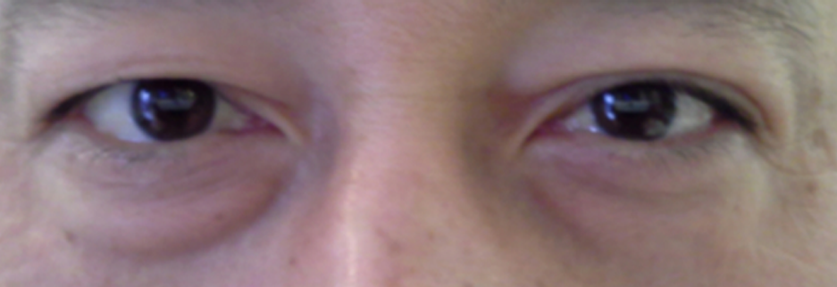 Before: Lower blepharoplasty for a man in his 50s, two weeks after surgery