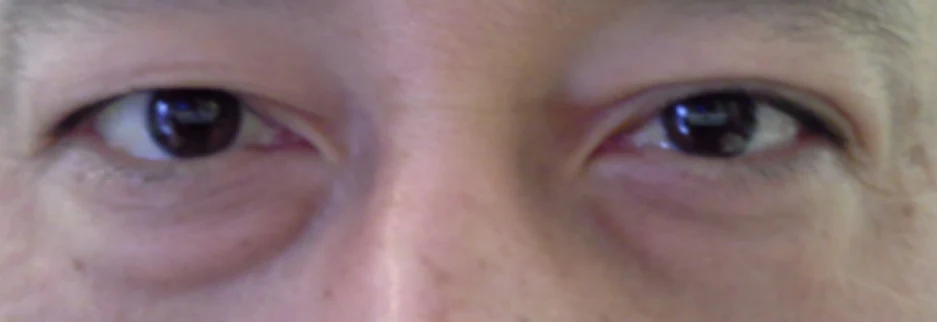 Before: Lower blepharoplasty for a man in his 50s, two weeks after surgery