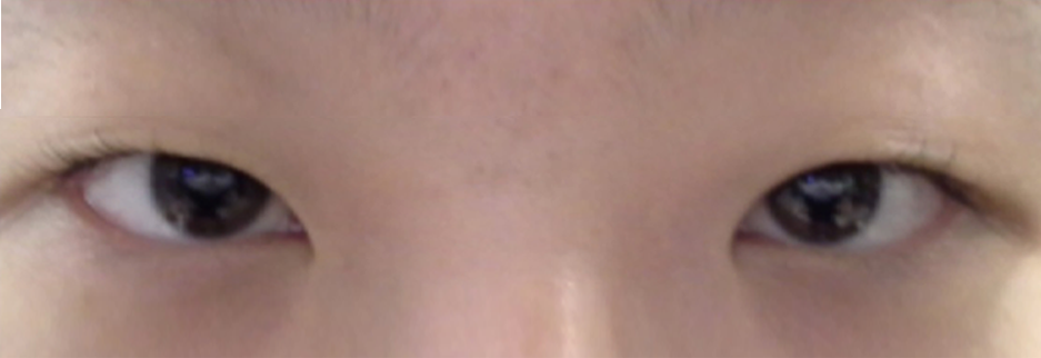 Before: Non incisional double eyelid with ptosis correction, one month after surgery