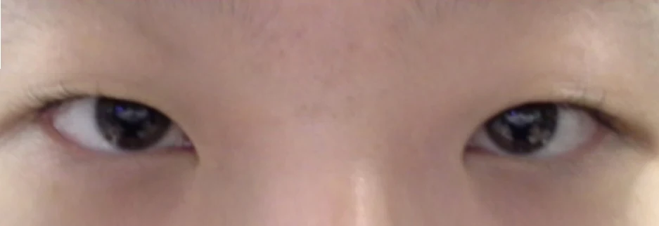 Before: Non incisional double eyelid with ptosis correction, one month after surgery