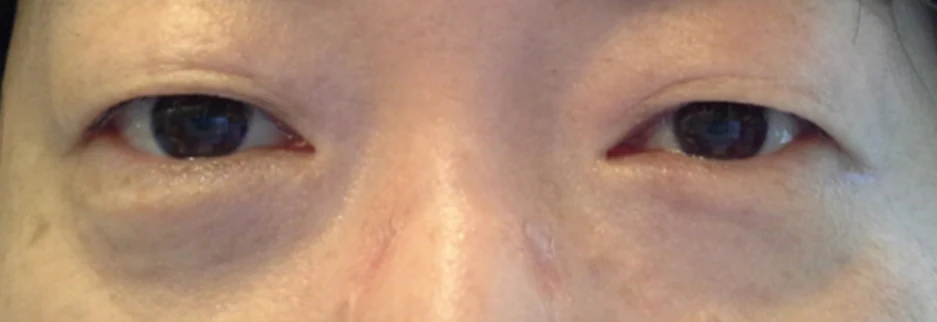 Before: Upper blepharoplasty for a woman in her 50s, three months after surgery