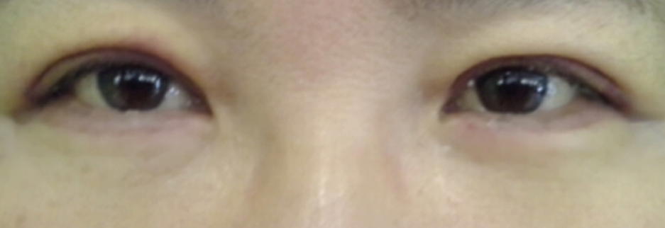 After: Lower blepharoplasty for a woman in her 50s, one week after surgery