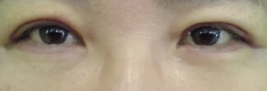 After: Lower blepharoplasty for a woman in her 50s, one week after surgery