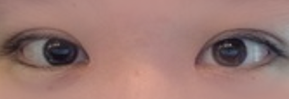 After: Non incisional double eyelid with ptosis correction, two weeks after surgery