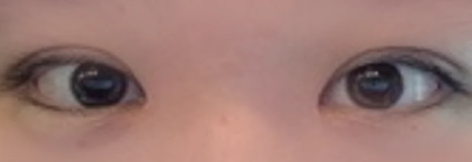 After: Non incisional double eyelid with ptosis correction, two weeks after surgery