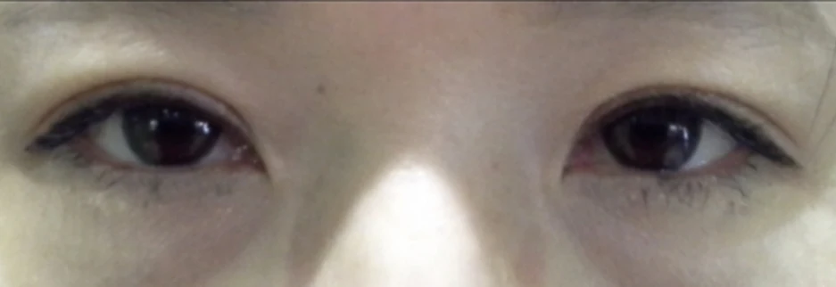 After: Upper blepharoplasty for a woman in her 50s, two months after surgery