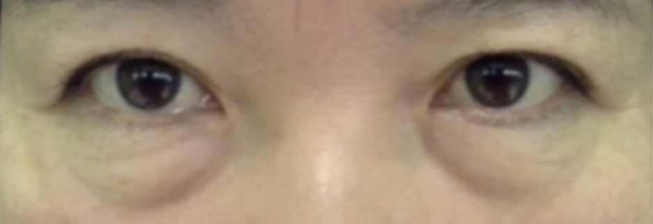 Before: Lower blepharoplasty for a woman in her 50s, one week after surgery